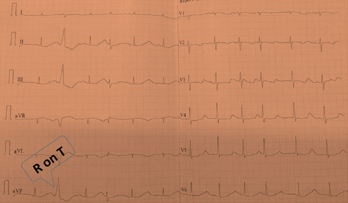 Electrocardiography showing short-coupled ventricular premature contraction with R on T phenomenon.